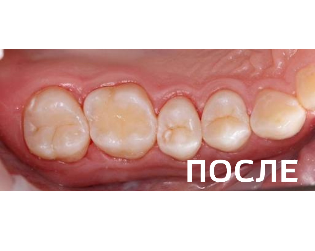 Лечение контактного кариеса