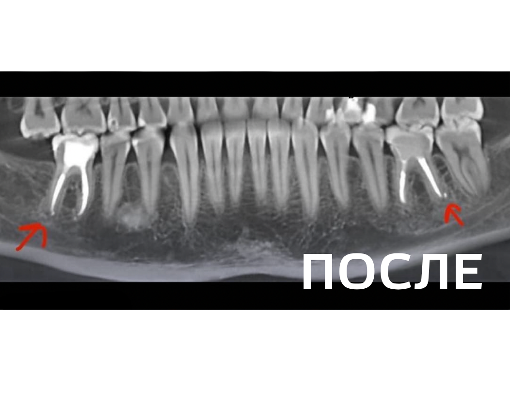 Лечение периодонтита