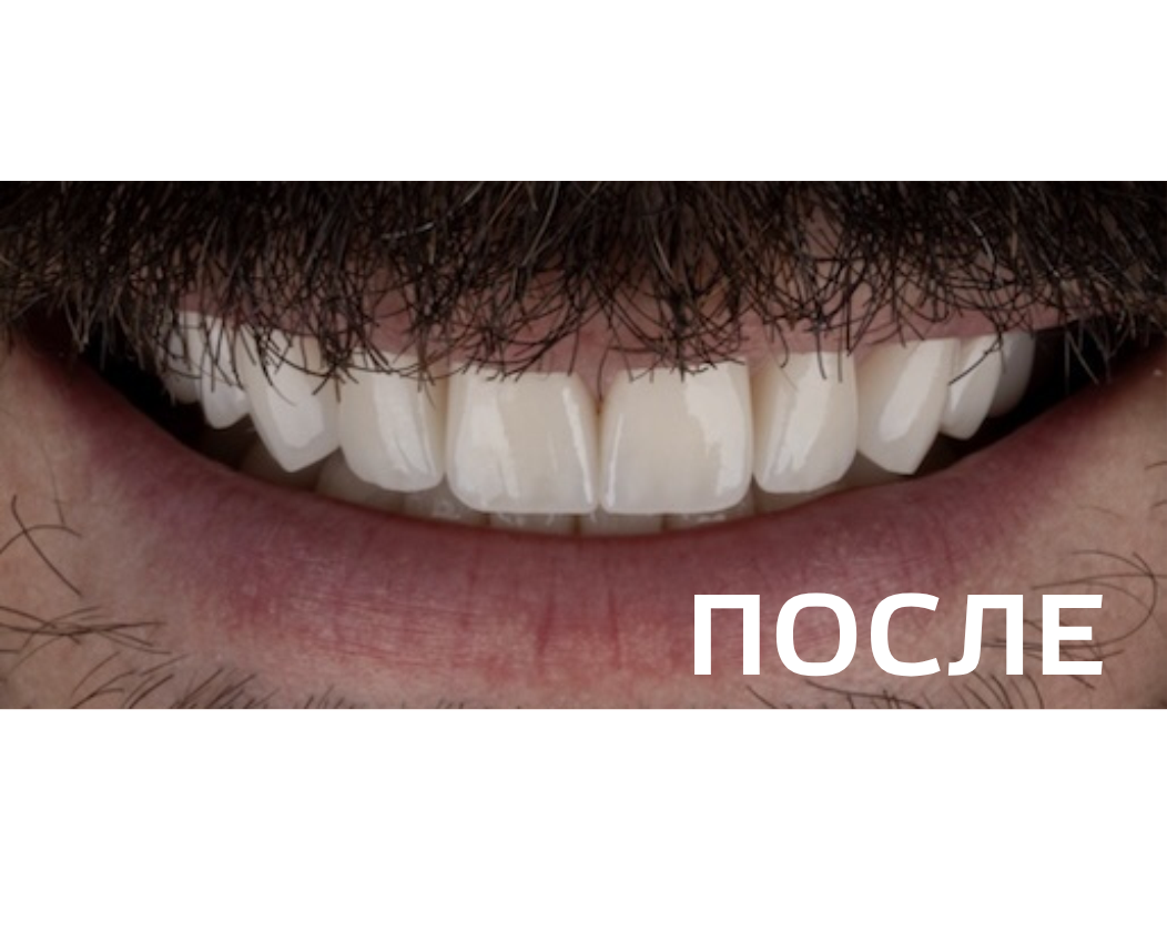 Восстановление эстетики улыбки с помощью керамических реставраций