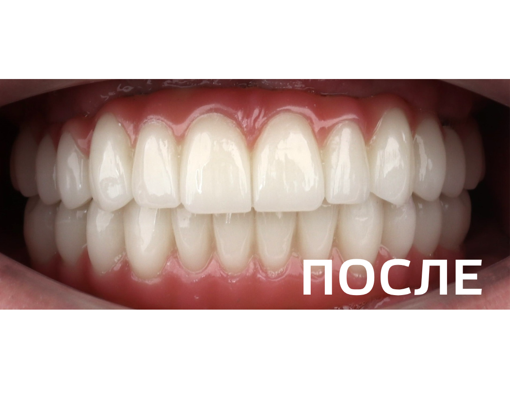 Метод "All-on-4"