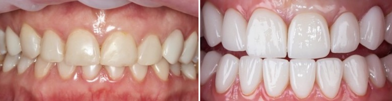 Фото до и после - Профгигиена полости рта у детей