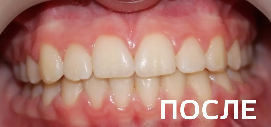 Фото после - Исправление прикуса, выравнивание зубов