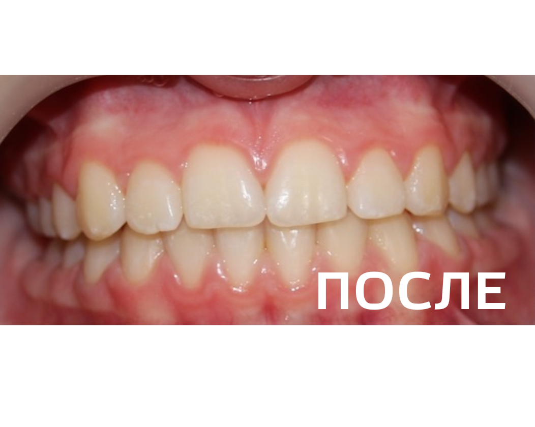 Исправление прикуса, выравнивание зубов