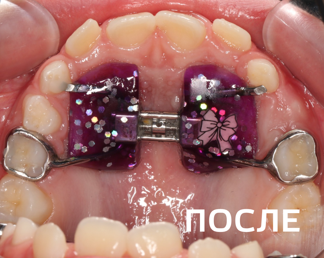 Фото до и после - Керамические брекеты