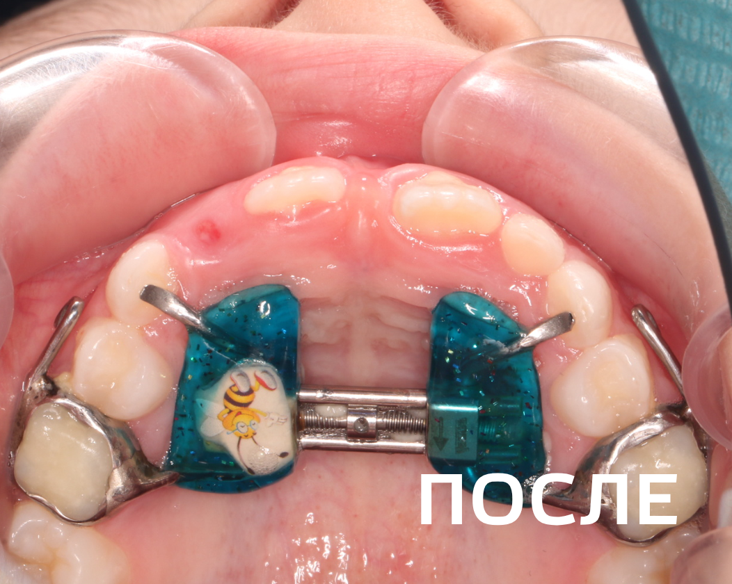 Фото до и после - Керамические брекеты