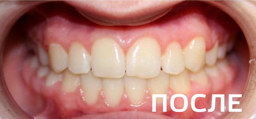 Фото после - Исправление прикуса, выравнивание зубов