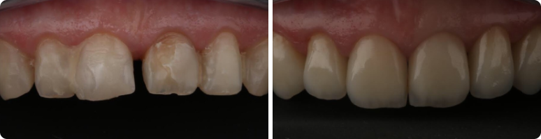 Фото до и после - Панорамный снимок зубов