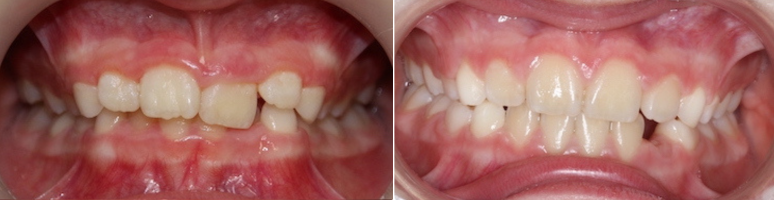 Фото до и после - Исправление прикуса, выравнивание зубов