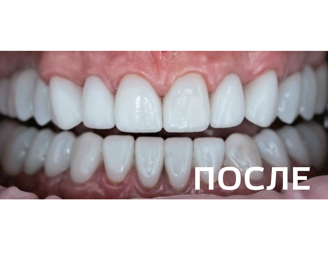 Комплексное ортопедическое восстановление зубных рядов 