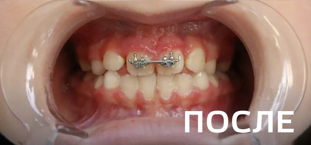 Фото после - Исправление прикуса, выравнивание зубов