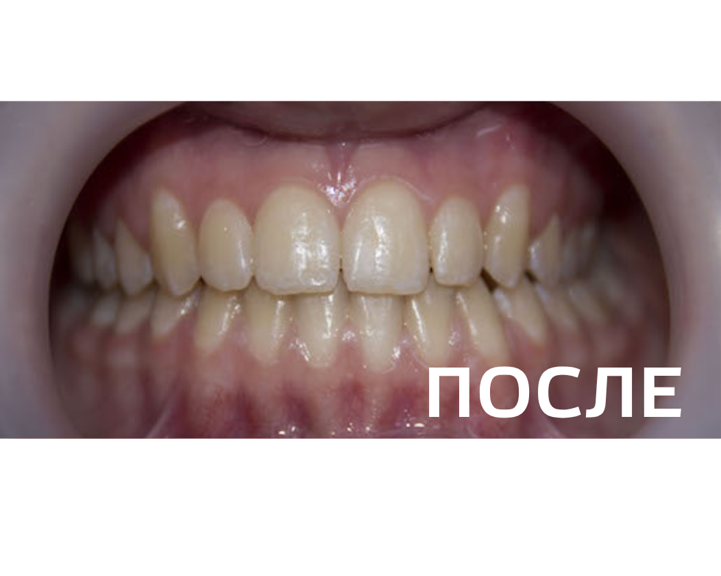 Исправление прикуса, выравнивание зубов