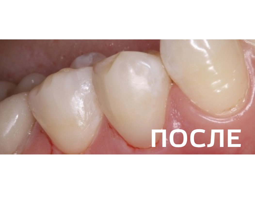  Лечение клиновидных дефектов
