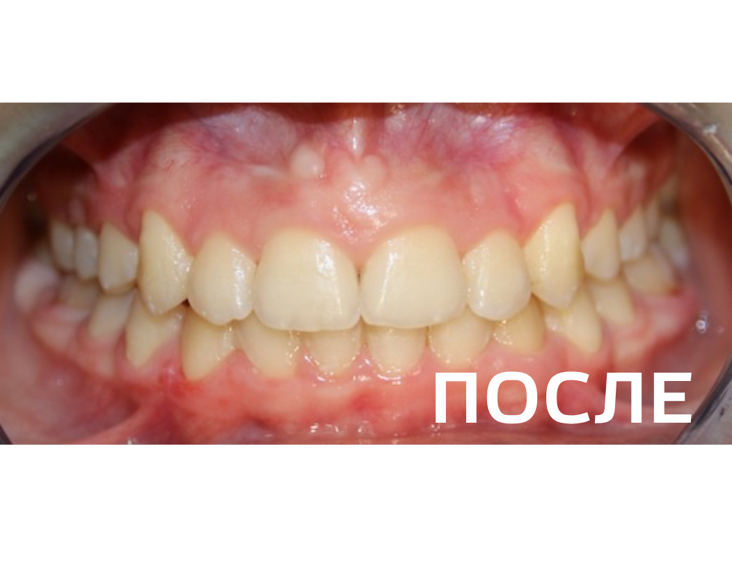 Исправление прикуса, выравнивание зубов
