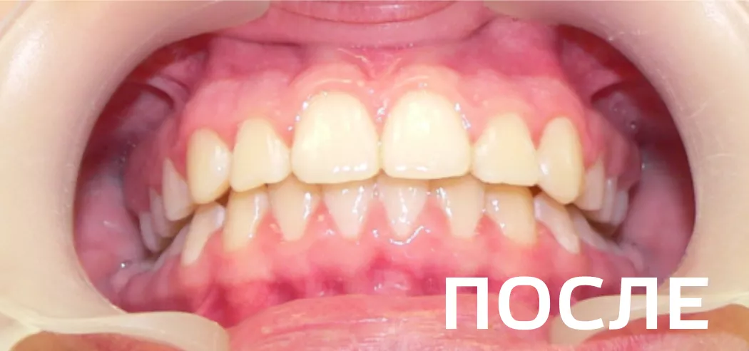 Фото после - Исправление прикуса, выравнивание зубов