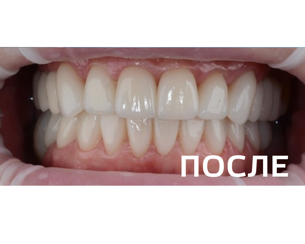 Комплексное восстановление зубных рядов керамическими винирами,  керамическими коронками  с опорой на зубы и импланты