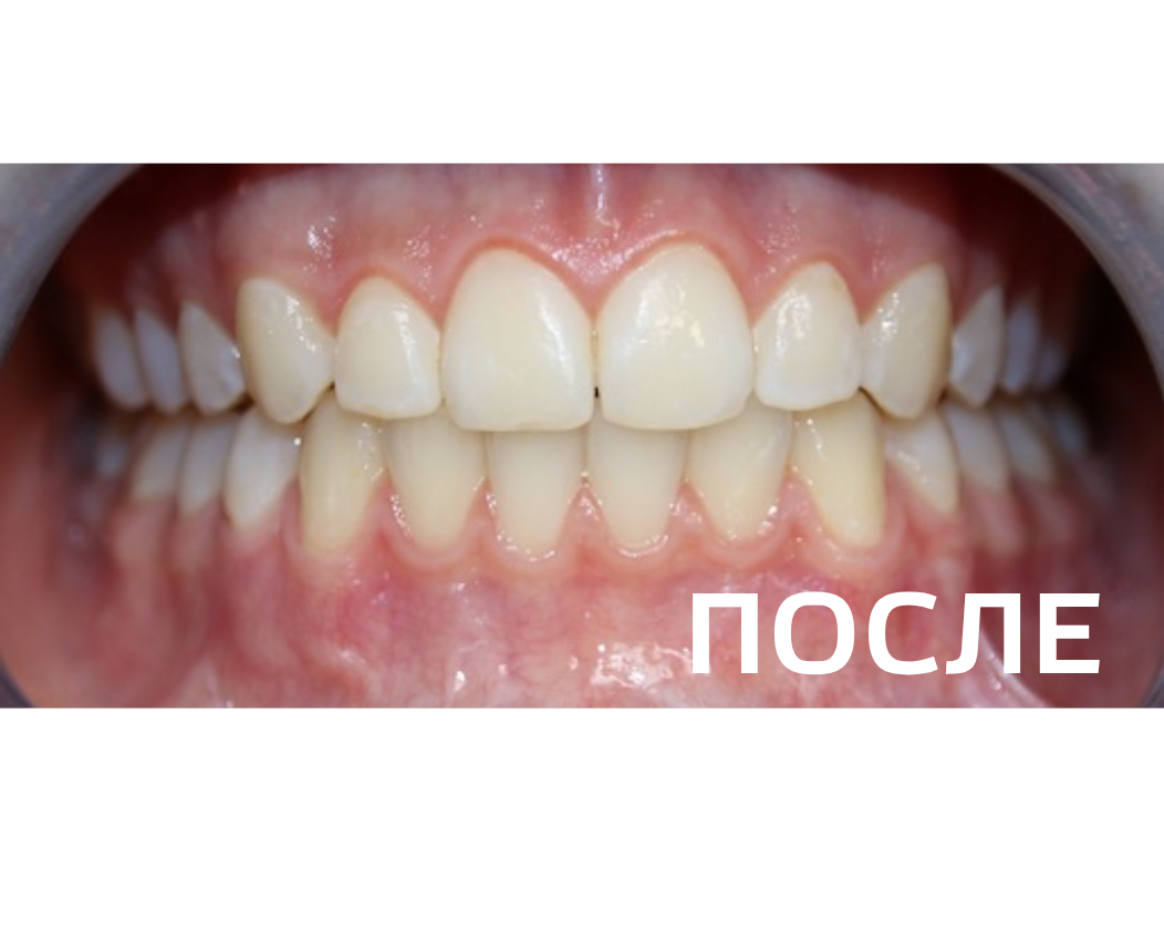 Исправление прикуса, выравнивание зубов