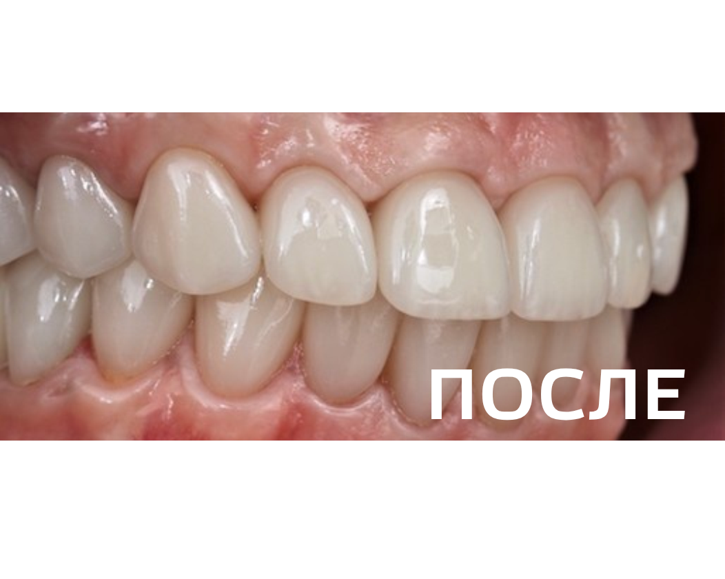 Ортопедическое восстановление зубов по методике All-on-6 