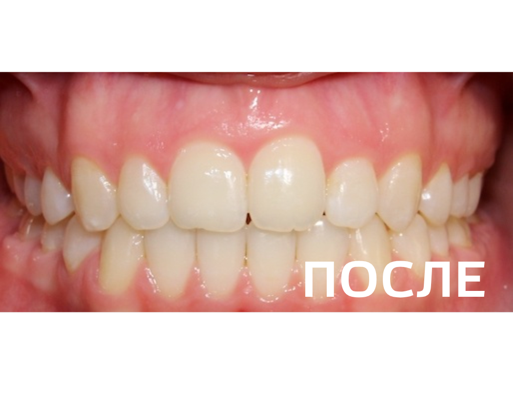 Исправление прикуса, выравнивание зубов