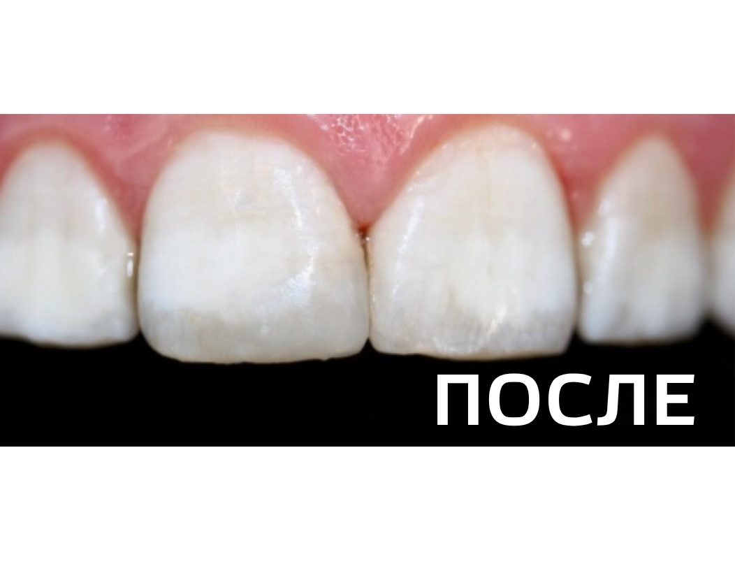 Реставрация  резца после травматического скола