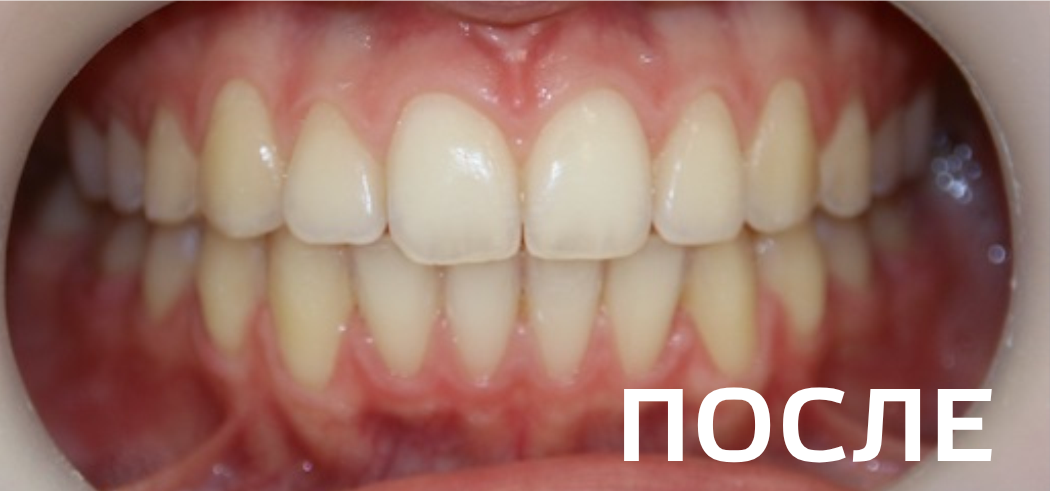 Фото после - Исправление прикуса, выравнивание зубов