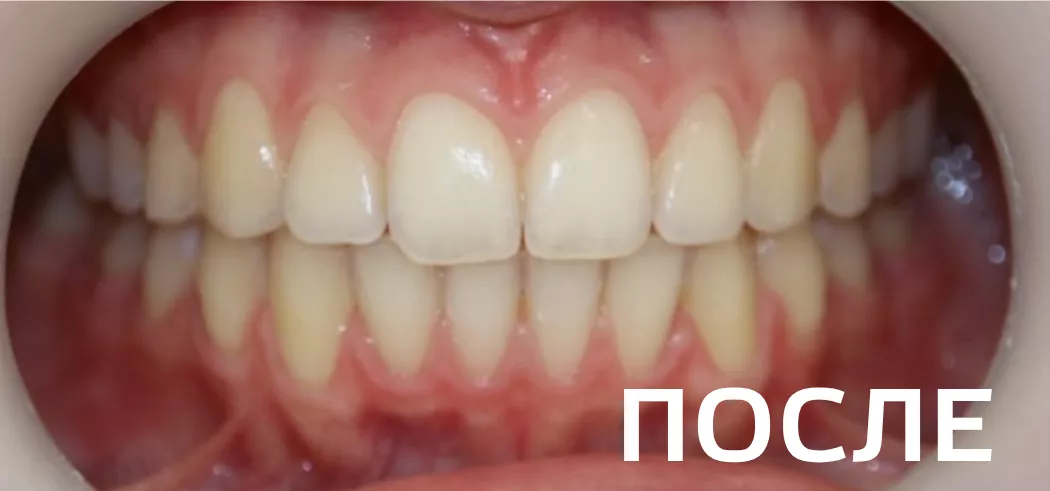 Фото после - Исправление прикуса, выравнивание зубов