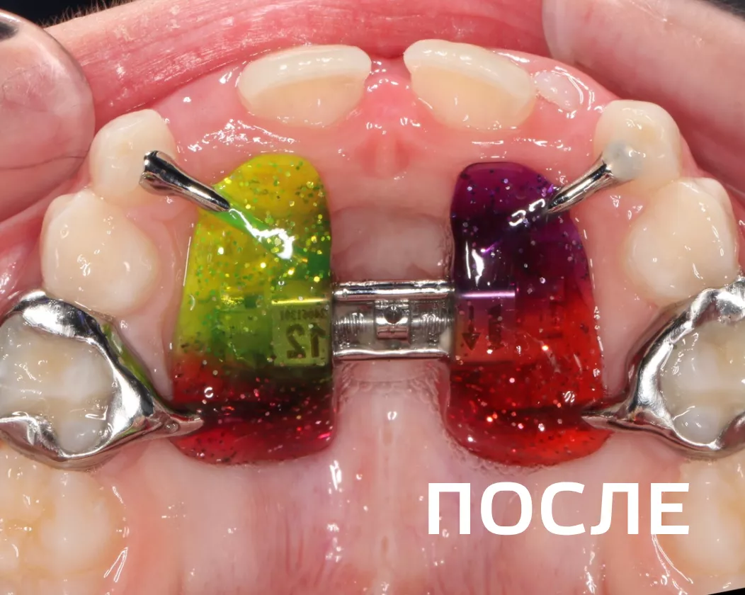 Фото после - Исправление прикуса несъемными аппаратами