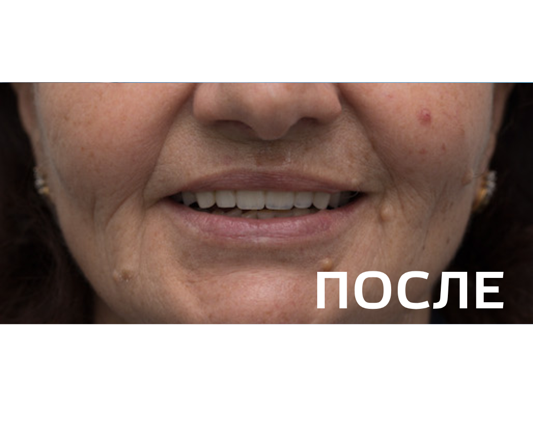 Ортопедическое восстановление зубов по методике All-on-6