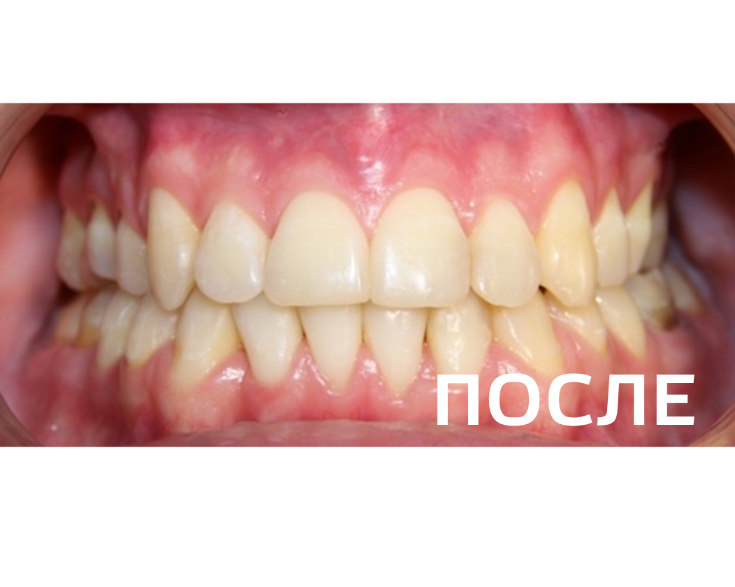 Исправление прикуса, выравнивание зубов