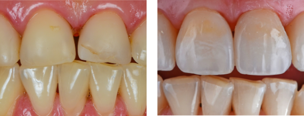 Фото до и после - Реставрация зубов