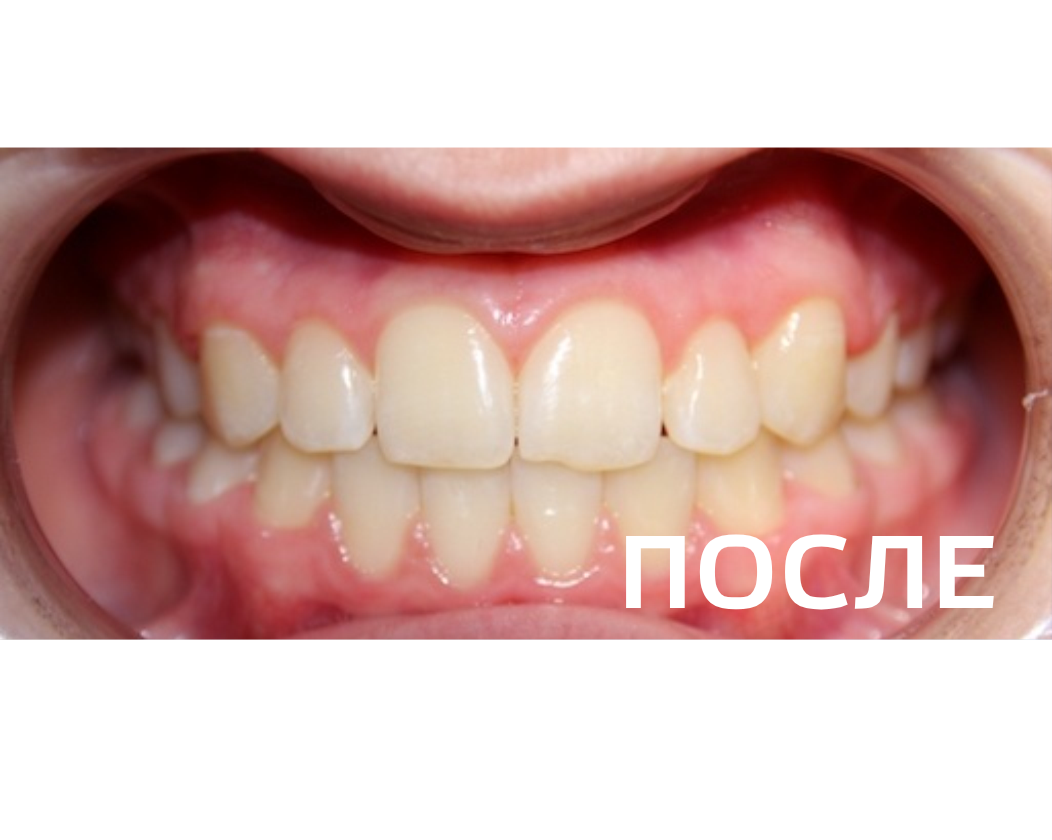 Исправление прикуса, выравнивание зубов