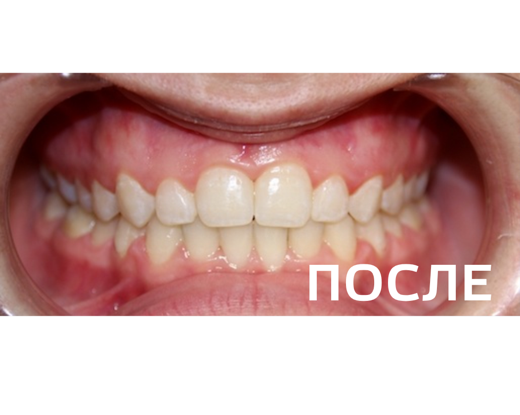 Исправление прикуса, выравнивание зубов
