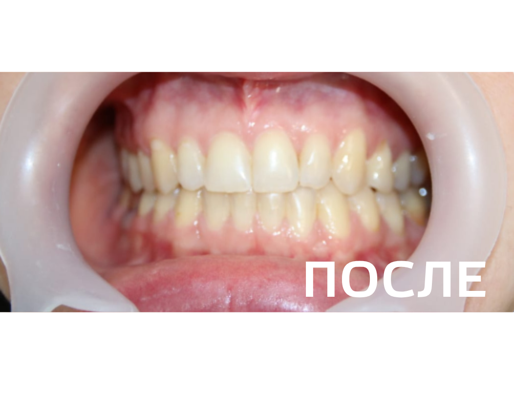 Исправление прикуса, выравнивание зубов