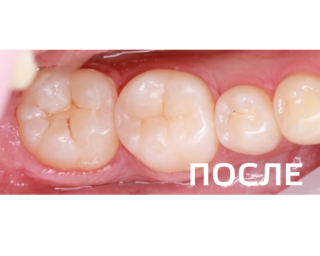 Лечение кариеса