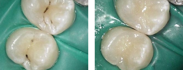 Фото до и после - Лечение кариеса дентина