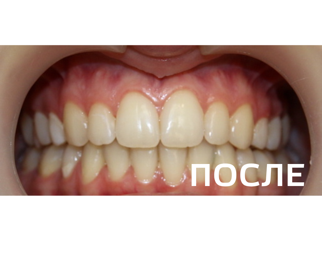 Исправление прикуса, выравнивание зубов