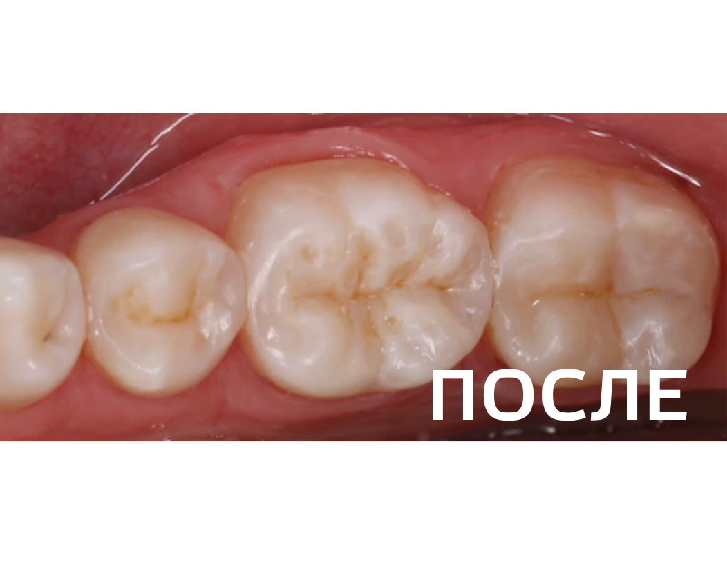 Лечение контактного кариеса
