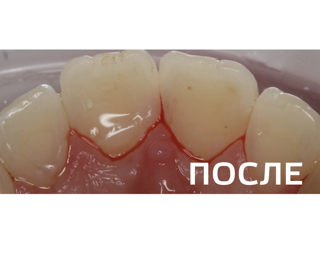 Лечение кариеса дентина