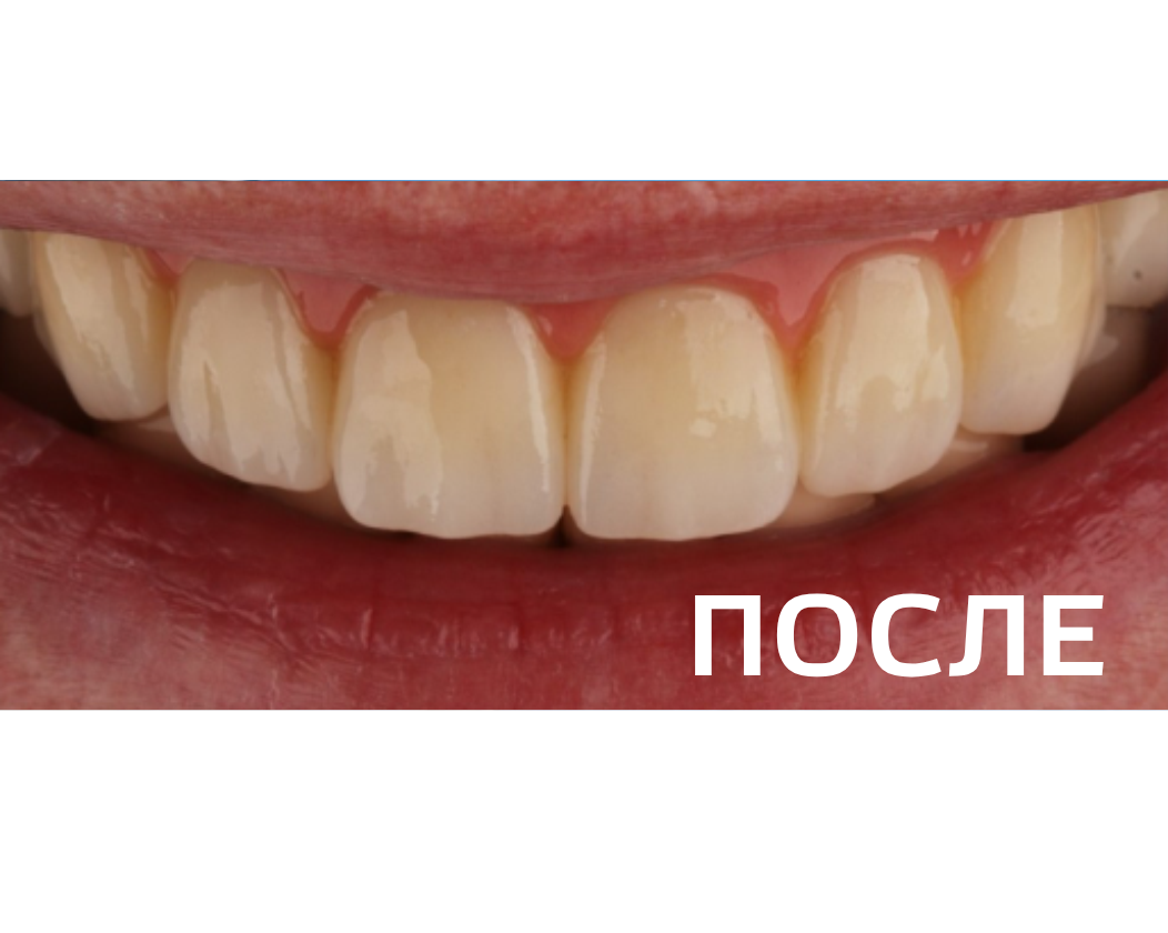 Восстановление зубных рядов методом  All-on-4