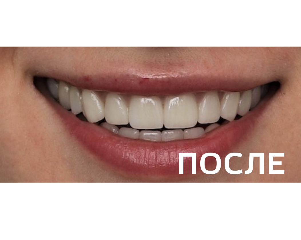 Комплексное ортопедическое восстановление зубных рядов 
