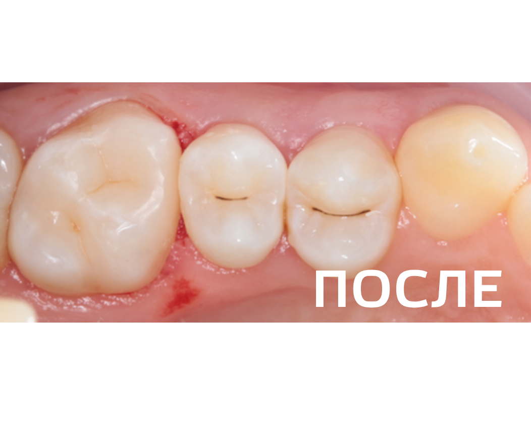 Лечение кариеса 