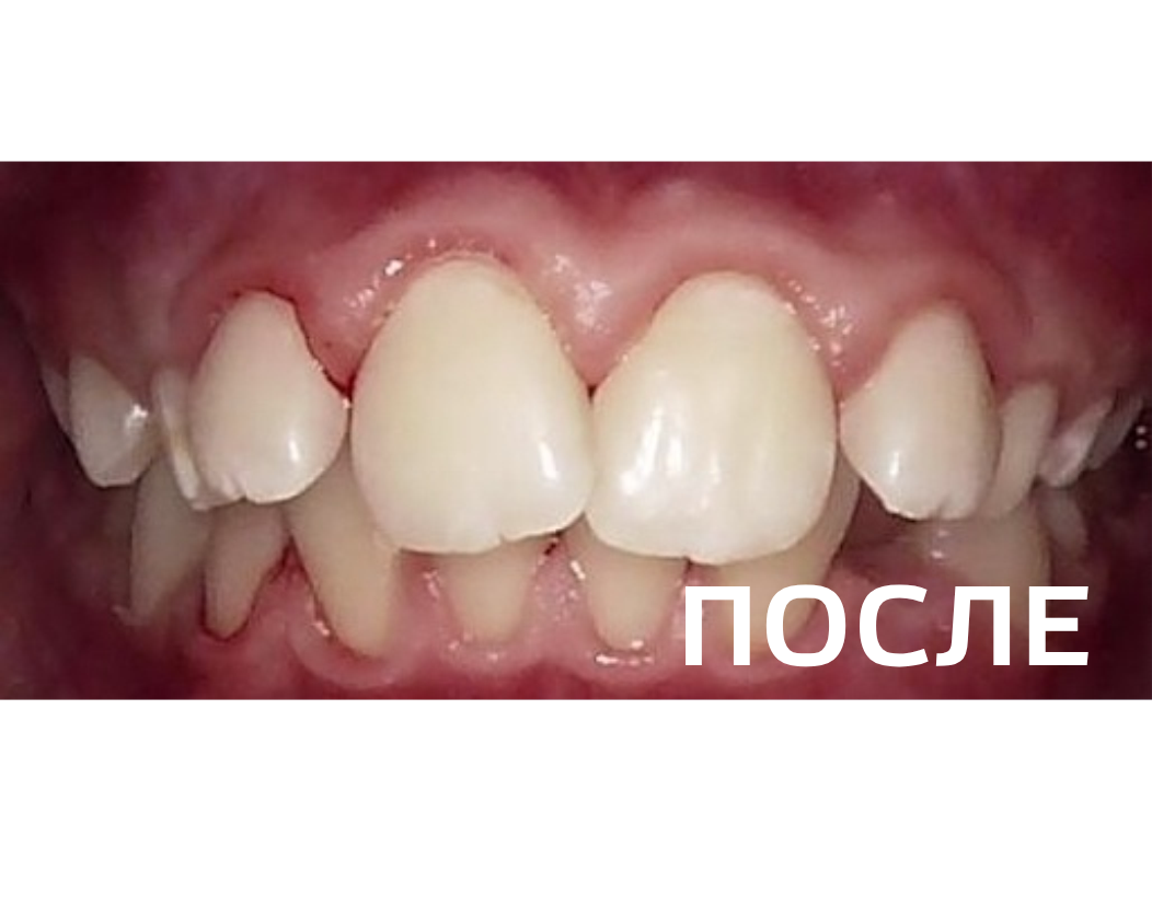 Профгигиена полости рта