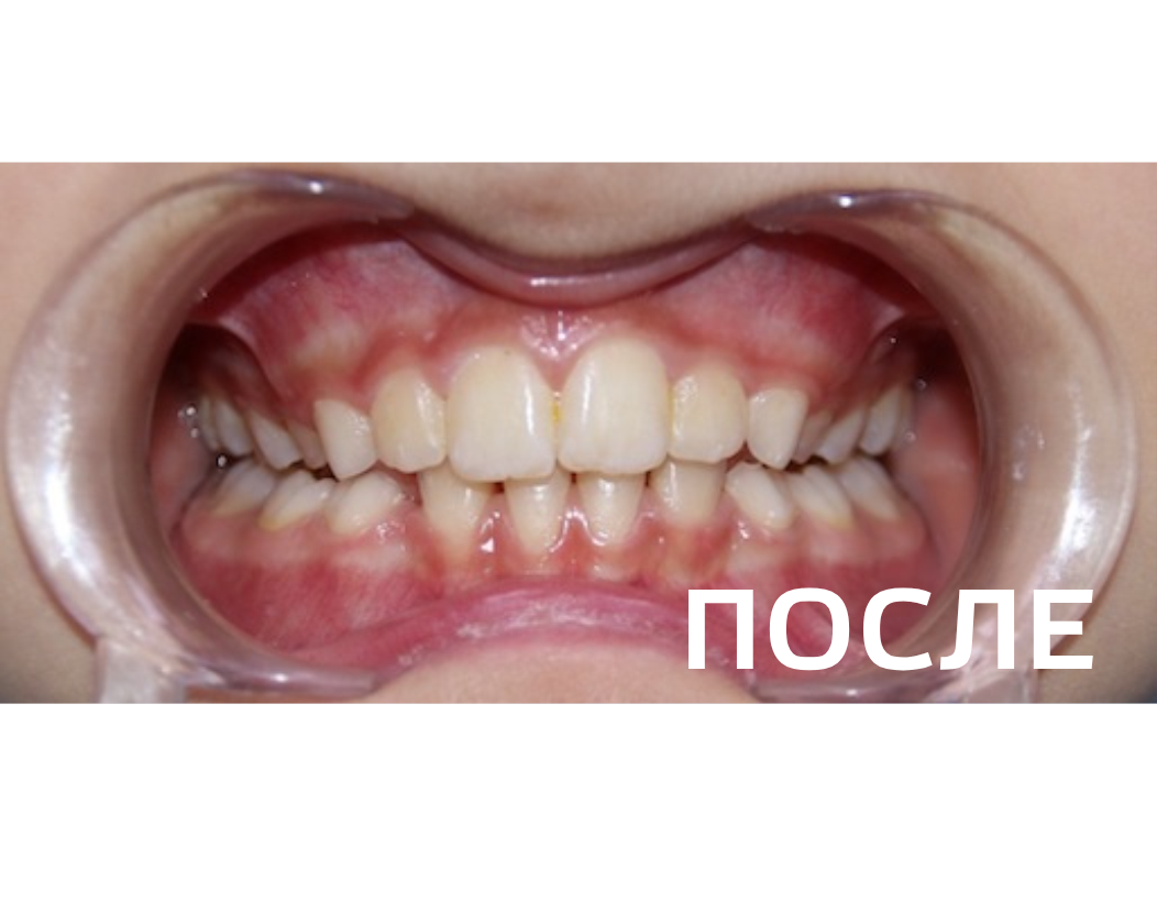 Исправление прикуса, выравнивание зубов