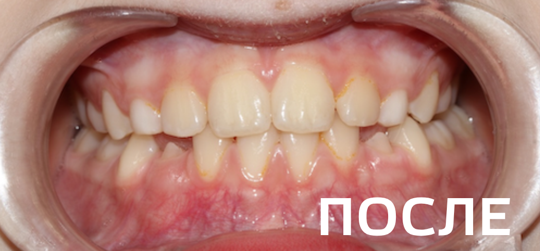 Фото после - Исправление прикуса, выравнивание зубов