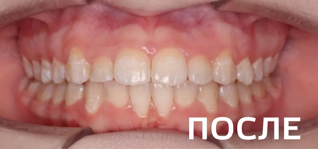 Фото после - Исправление прикуса, выравнивание зубов