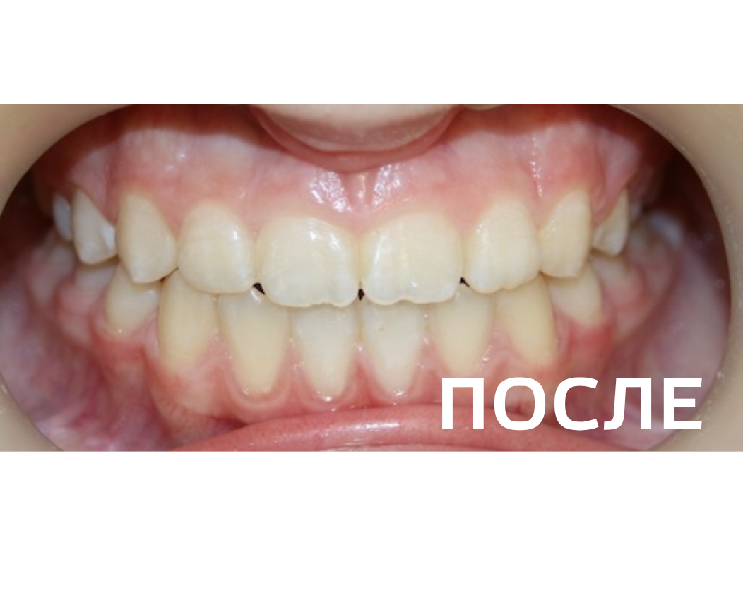 Исправление прикуса, выравнивание зубов