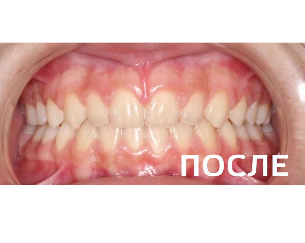 Исправление прикуса, выравнивание зубов