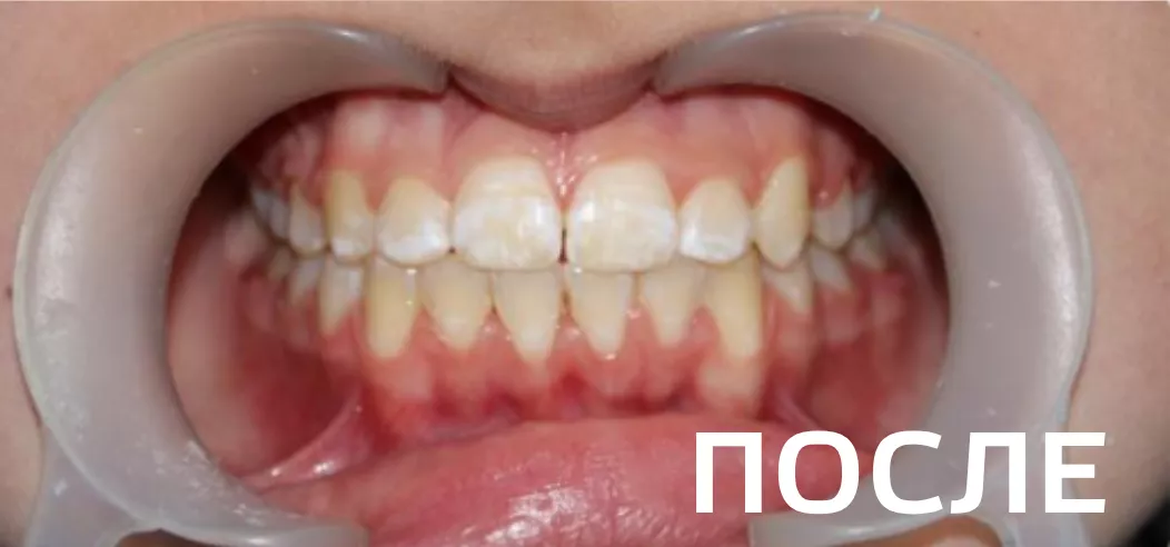 Фото после - Исправление прикуса, выравнивание зубов