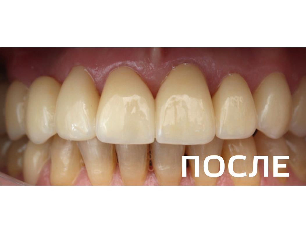 Комплексное восстановление зубов верхней челюсти