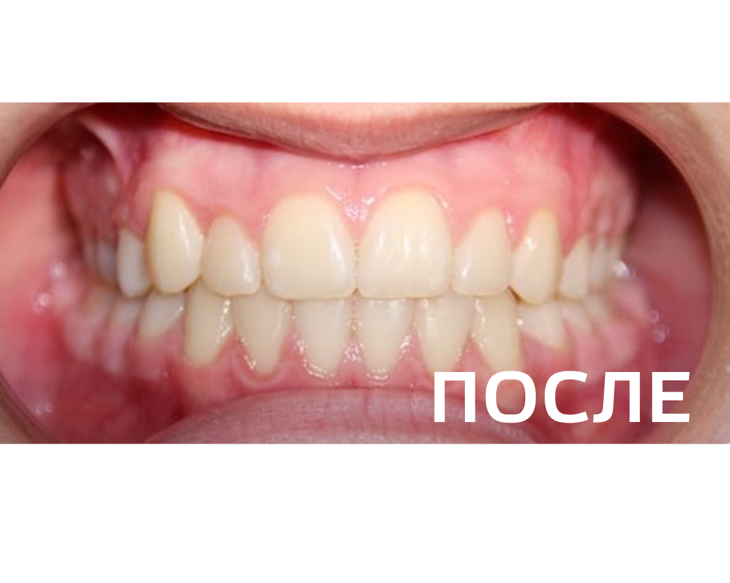 Исправление прикуса, выравнивание зубов