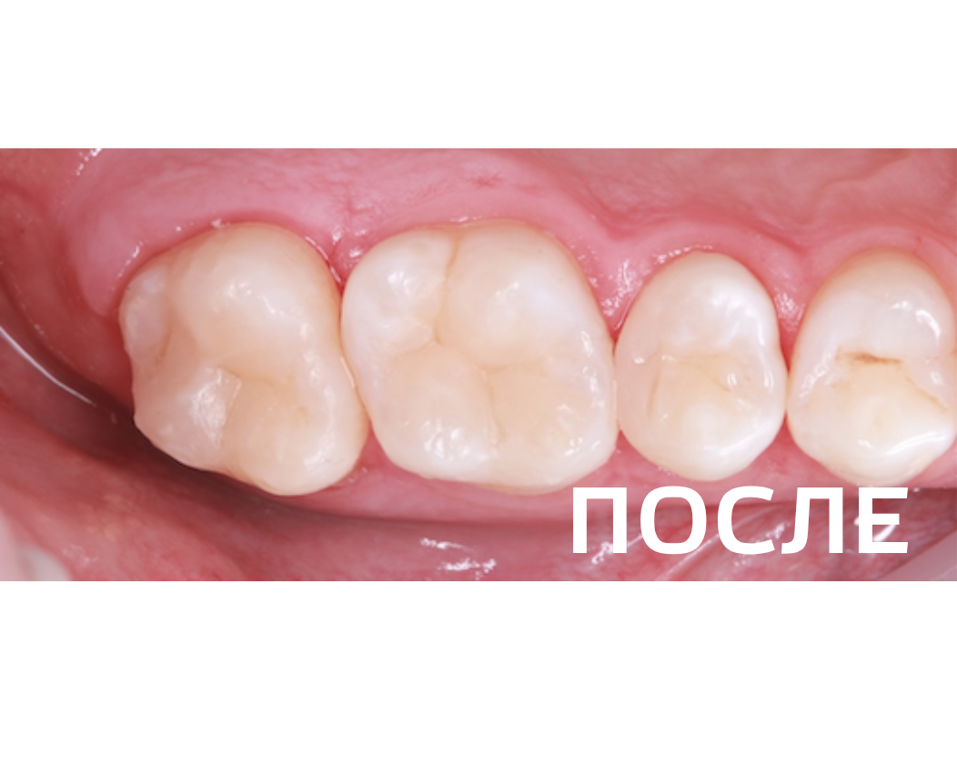 Лечение  кариеса